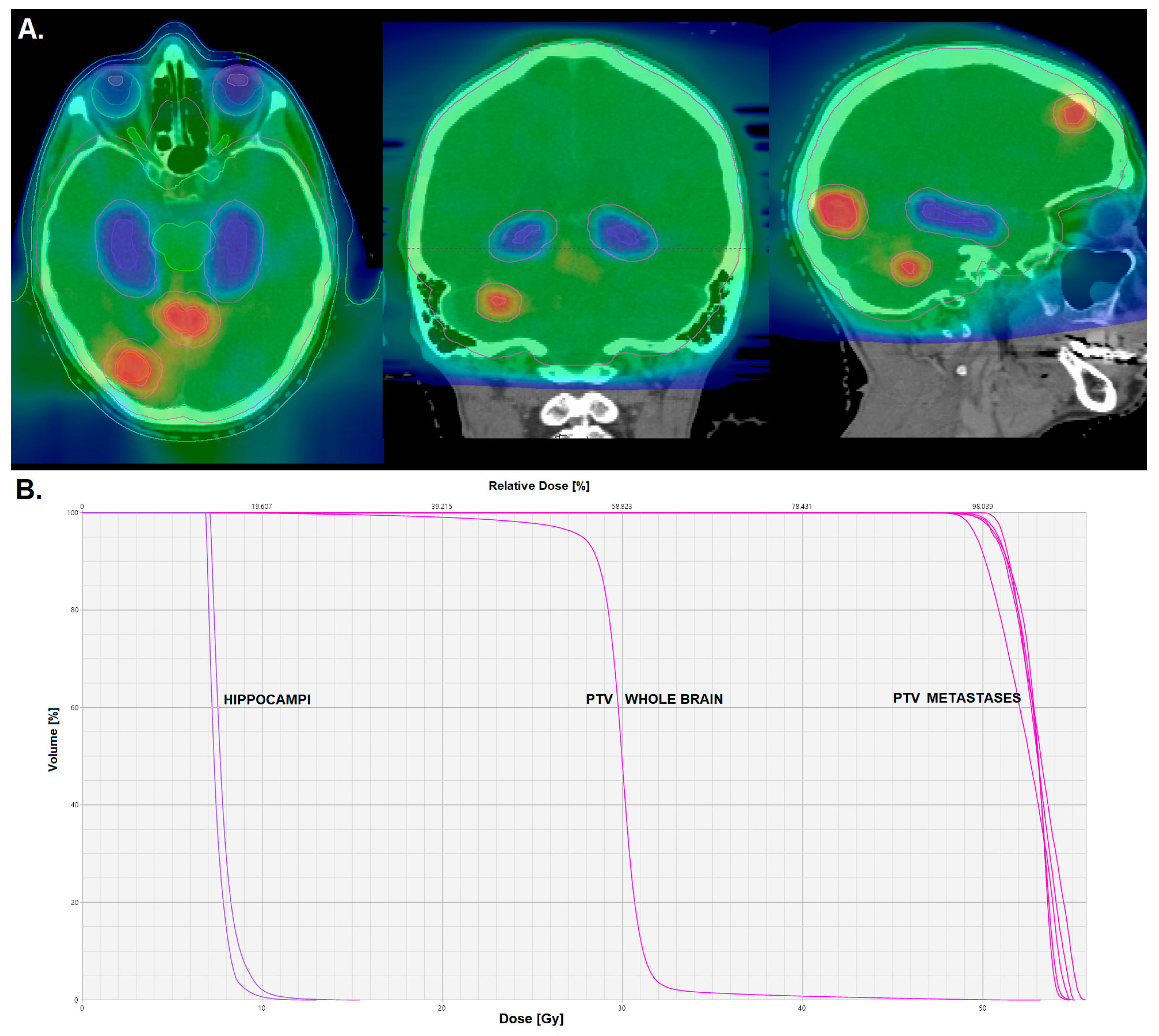 Do We Still Need Whole-Brain Irradiation for Brain Metastases? - Castalia Fernández