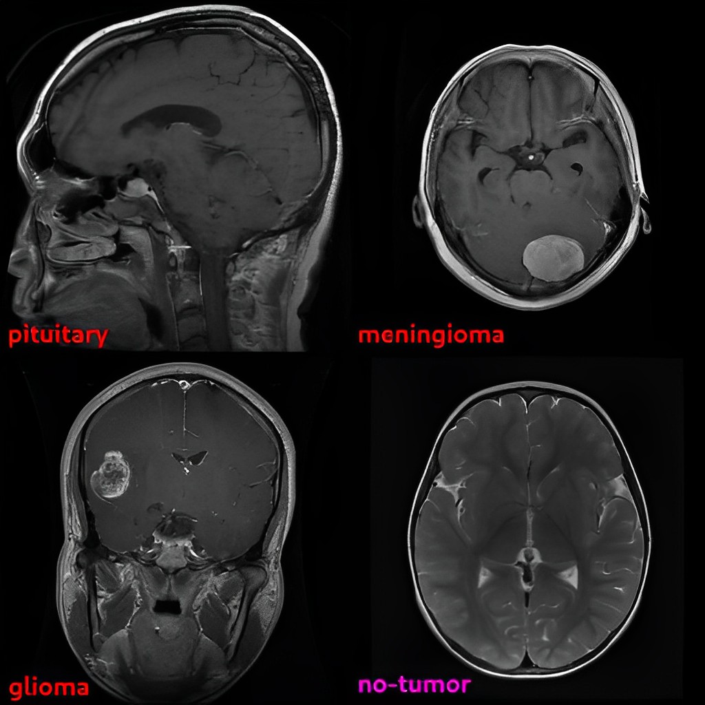 We've just achieved a stunning 92% accuracy in brain tumor classification using an unsupervised method - FiveBrane