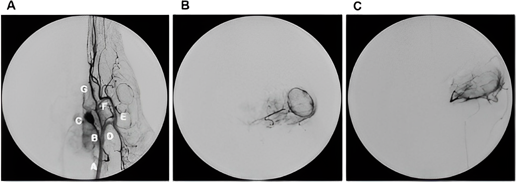 Guillermo Chantada: Great study of an animal model for testing the orbital disposition of topotecan after intra-arterial administration.