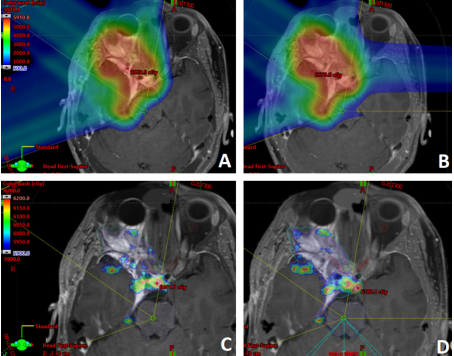 Jason Sheehan: Improving visual outcomes with the latest SRS and particle therapy approaches for skull-based tumors.