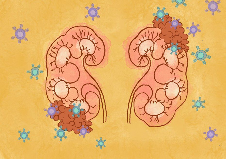 CD70-Targeted Allogeneic CAR T-Cell Therapy for Advanced Clear Cell Renal Cell Carcinoma, by Sumanta K. Pal et al - Cancer Discovery