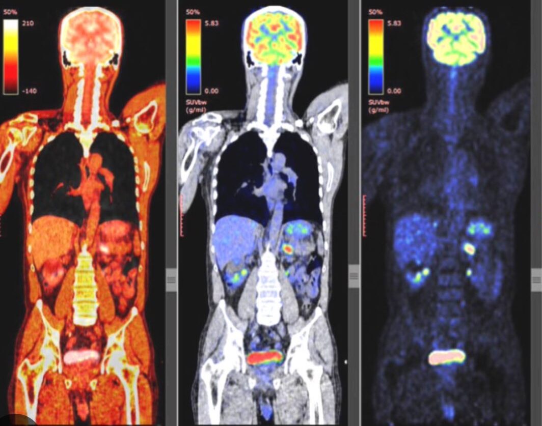 PET scans