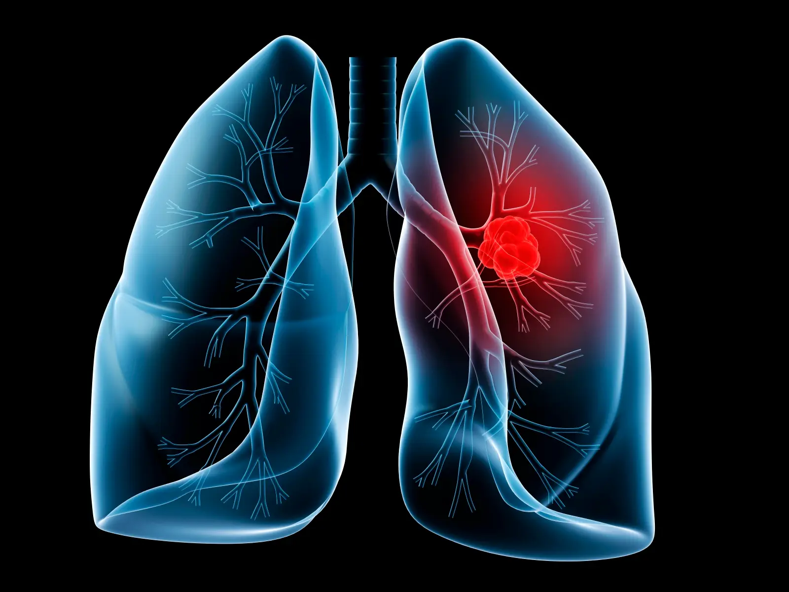 lung cancer