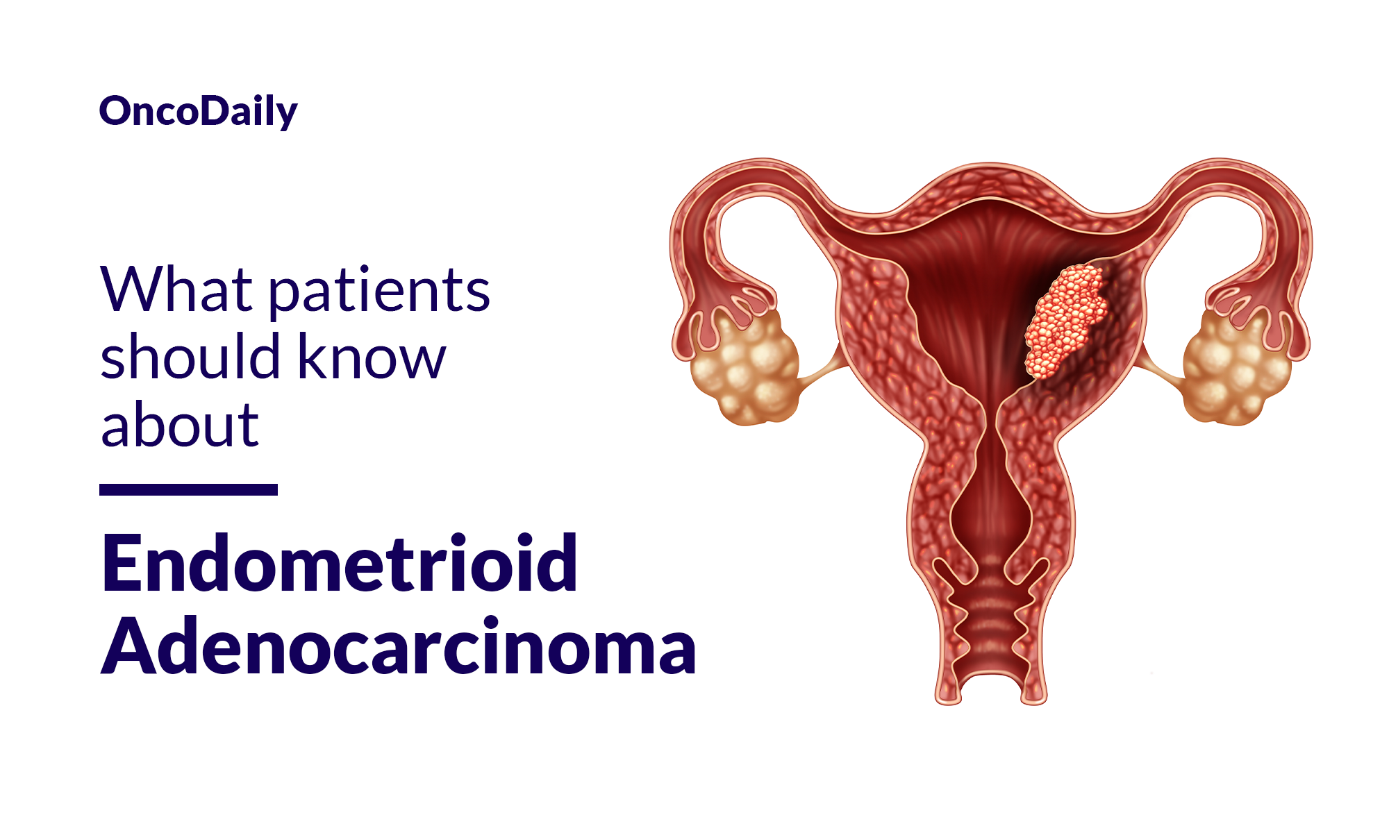 Endometrioid Adenocarcinoma