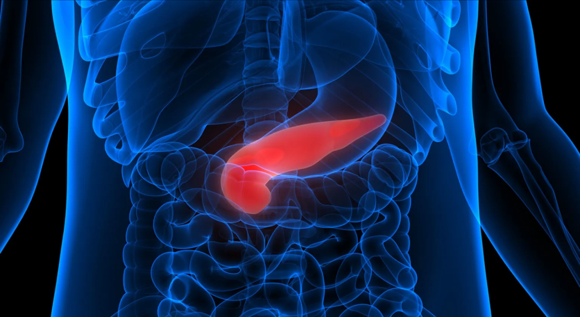 pancreatic cancer