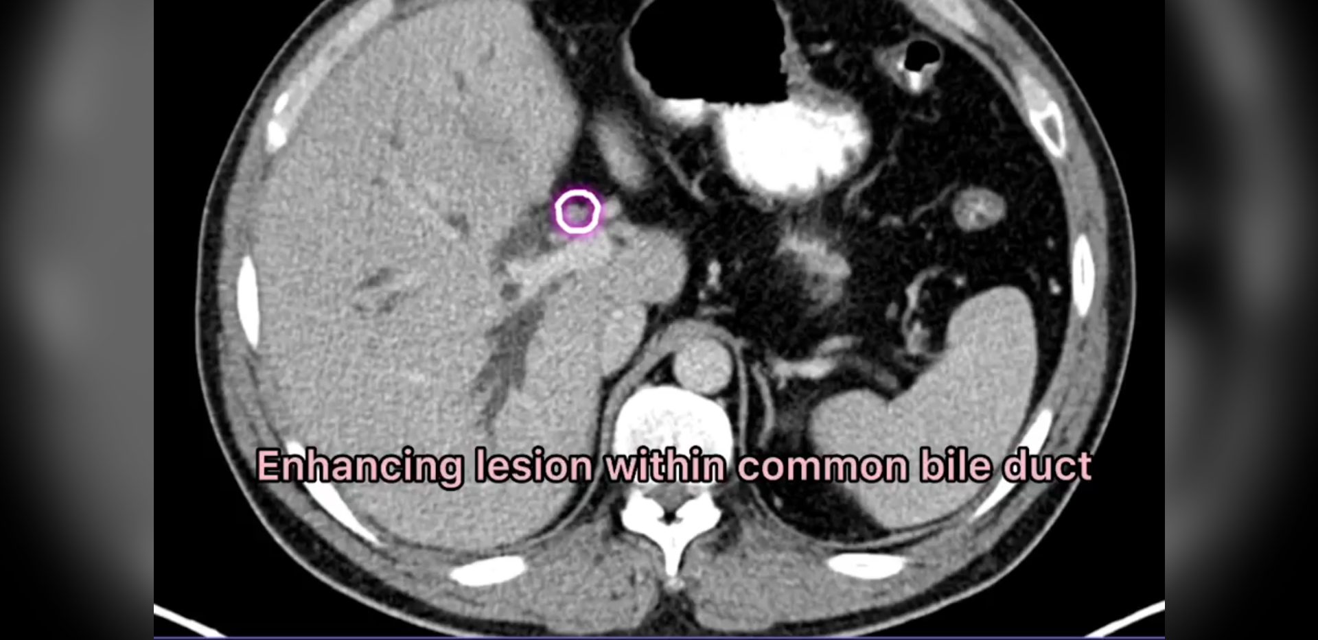 cholagiocarcinoma