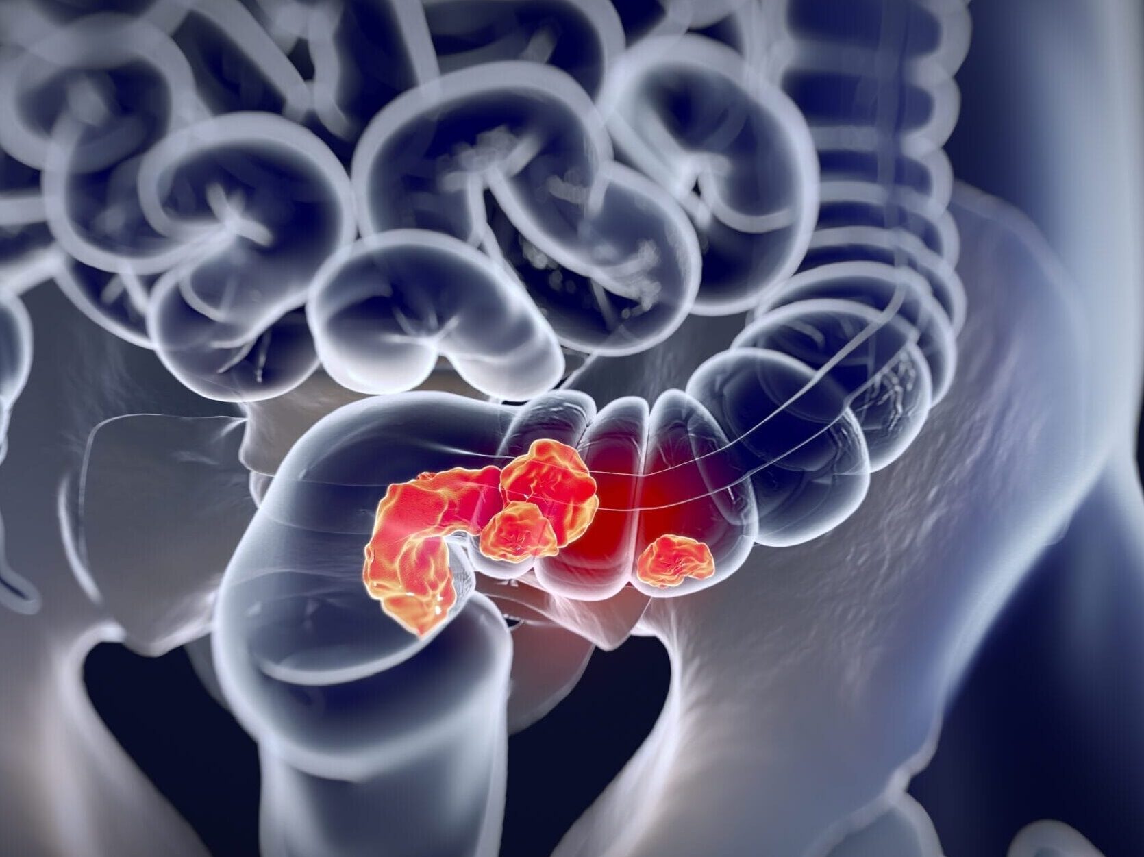 Annals of Oncology - Long-term results of the UNICANCER-PRODIGE 23 trial