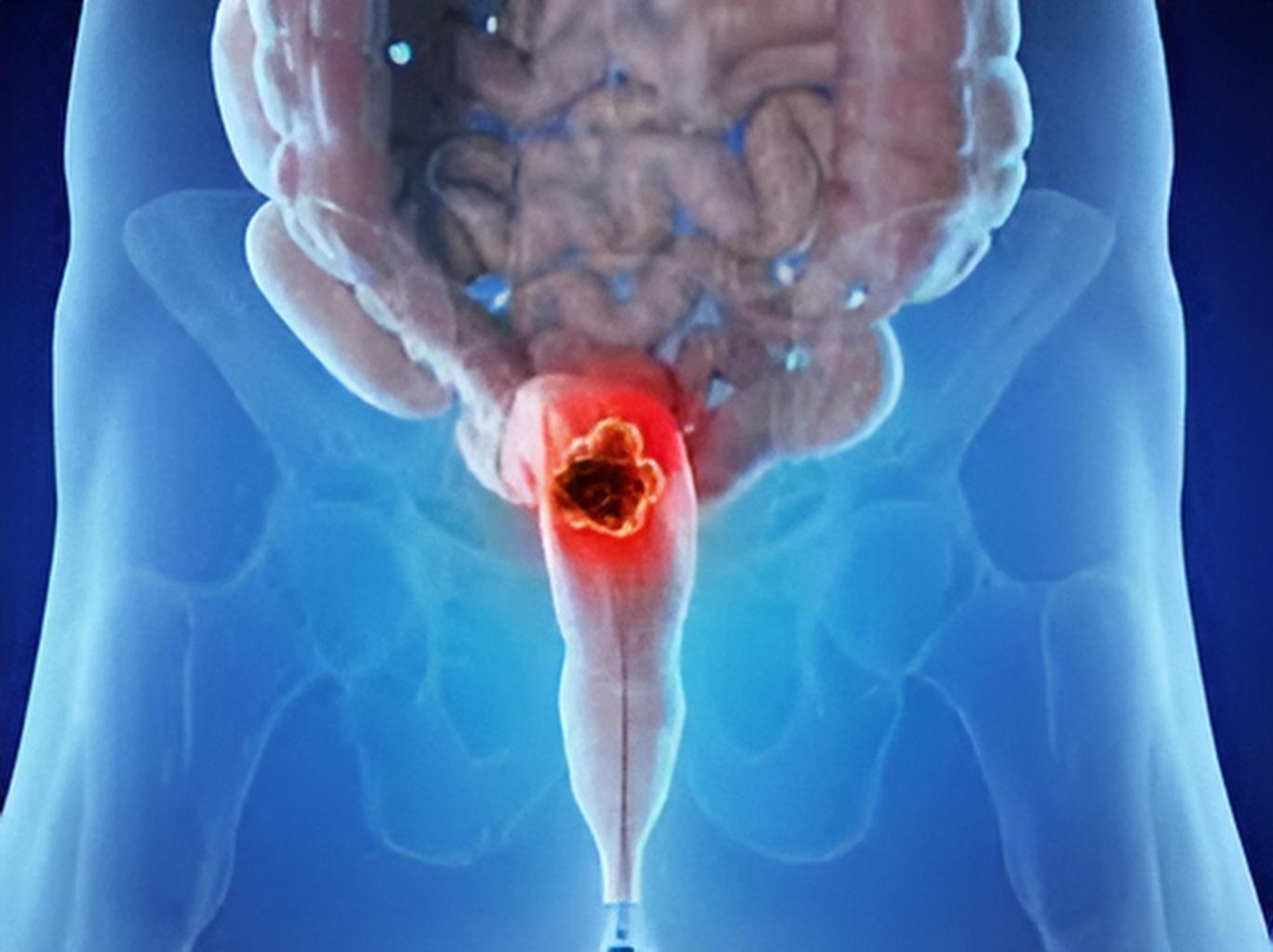 rectal cancer