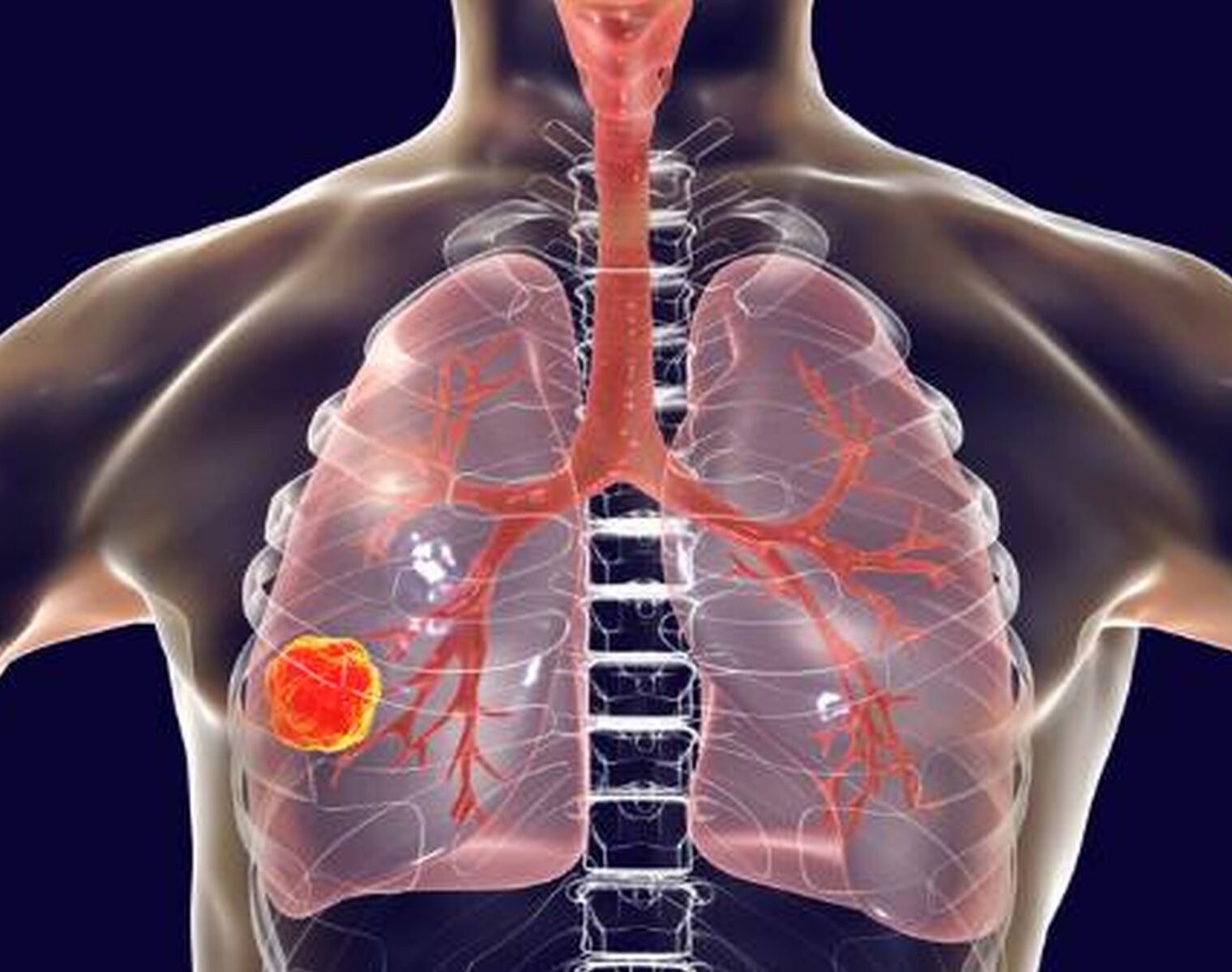 Subcutaneous amivantamab