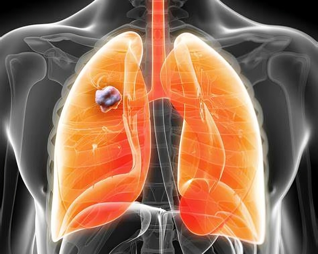 resectable NSCLC