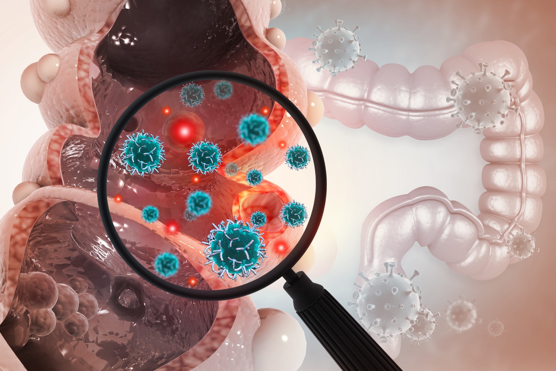 Metastatic Colorectal Cancer