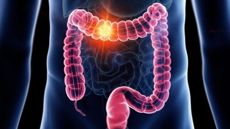 Photo of colorectal cancer
