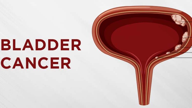 bladder cancer