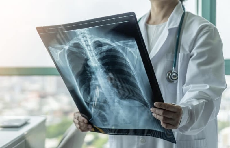 Lung cancer