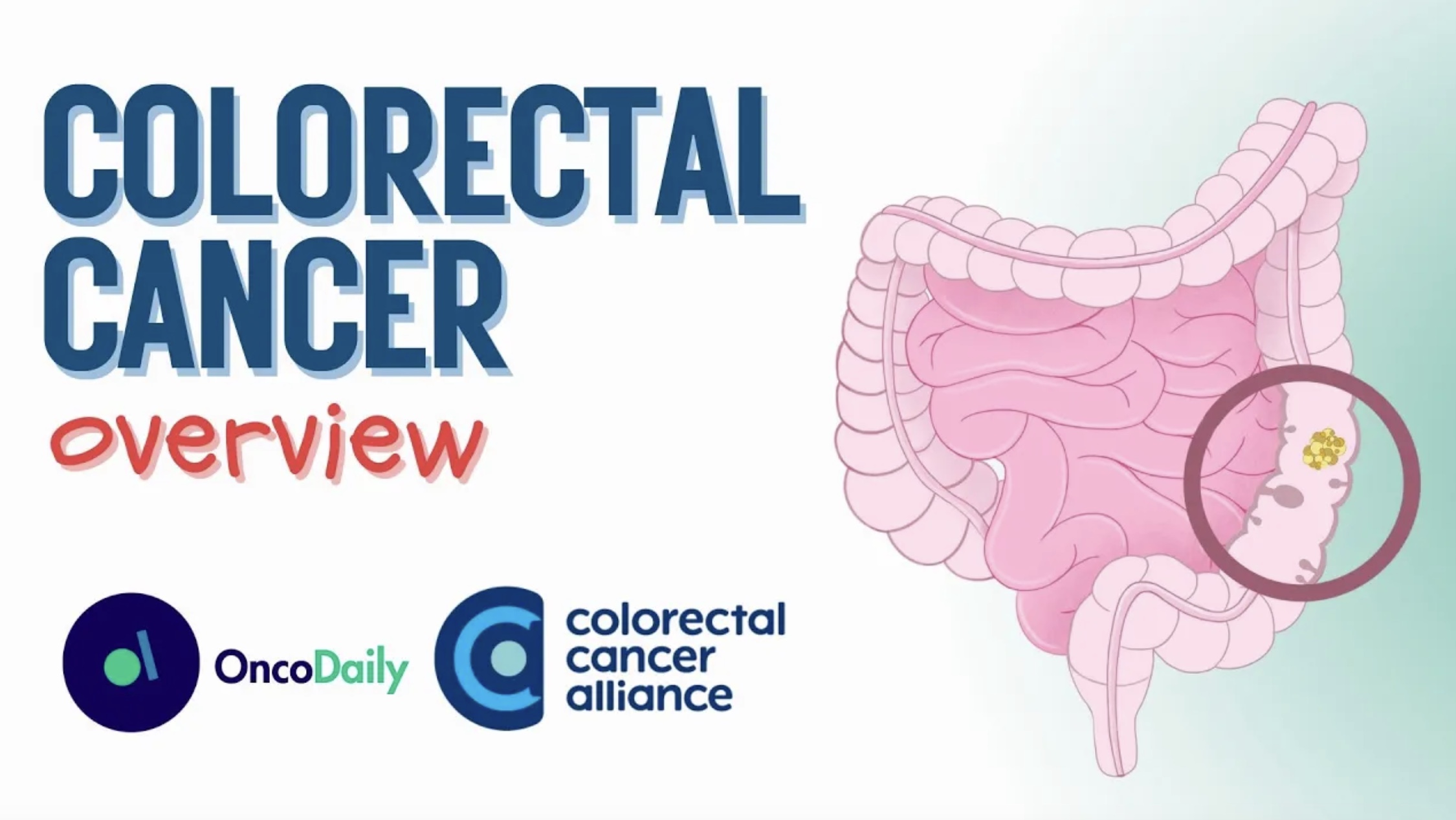 colorectal cancer