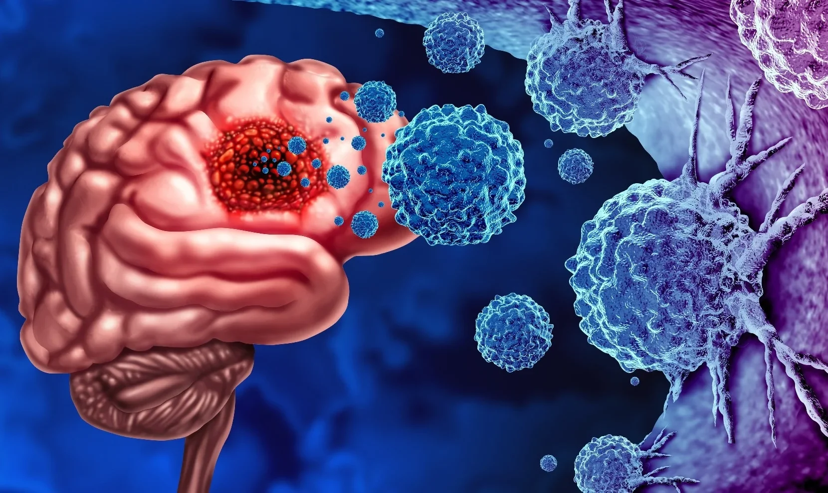 Impactful stats about Glioblastoma - National Brain Tumor Society