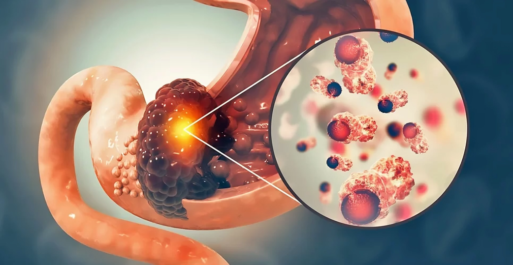 advanced Gastric Cancer