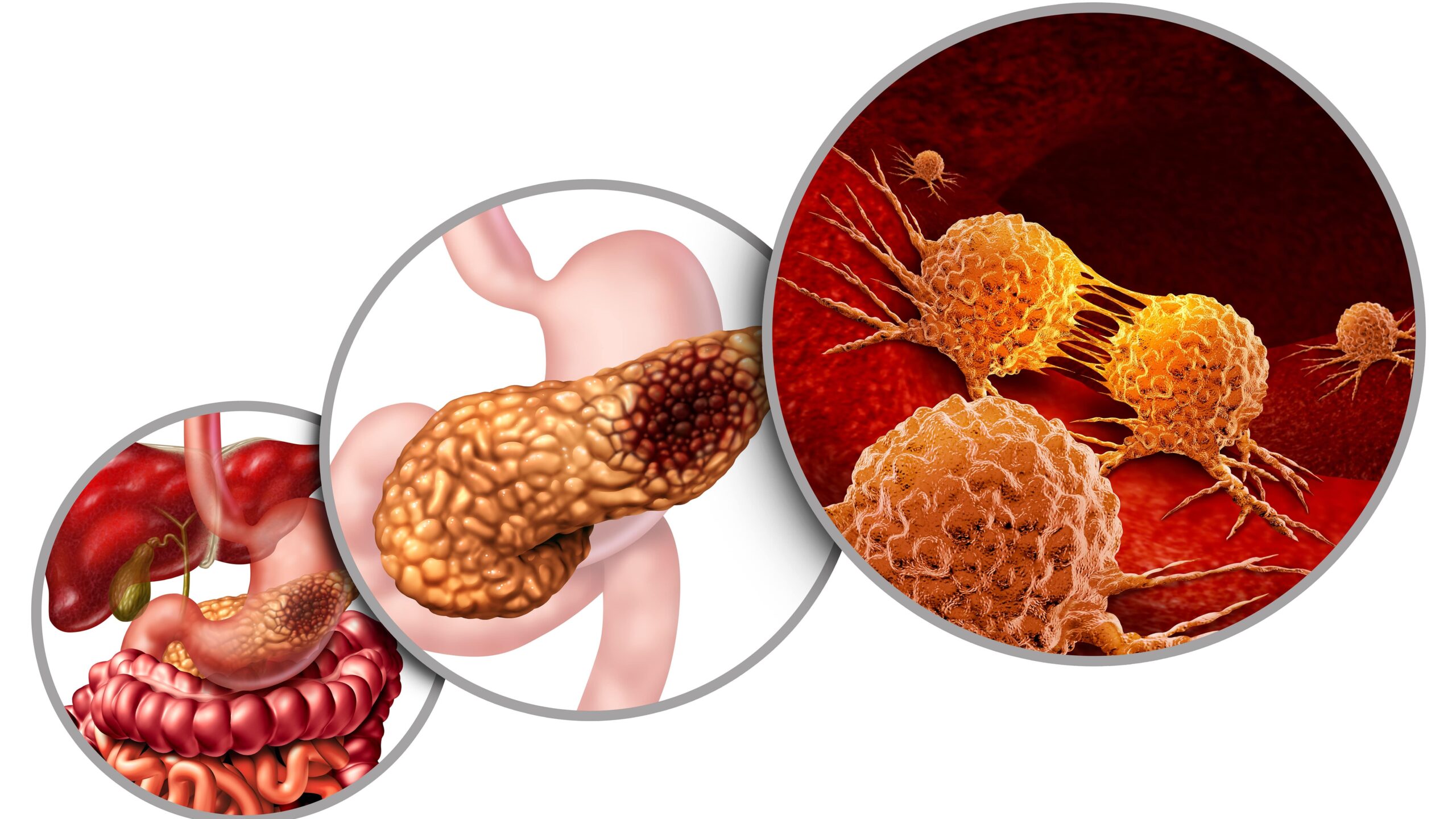 management of gastroenteropancreatic
