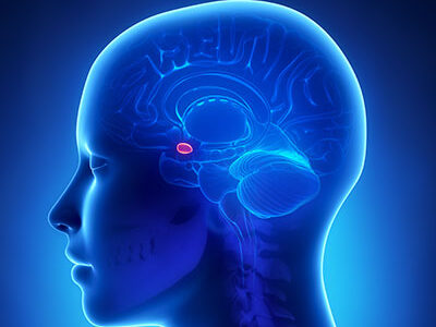Gliomatosis cerebri