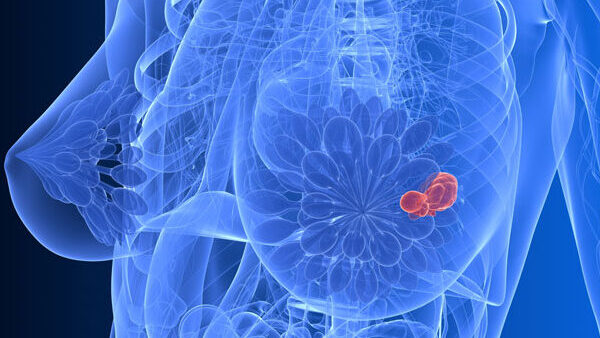 Metastatic Breast Cancer