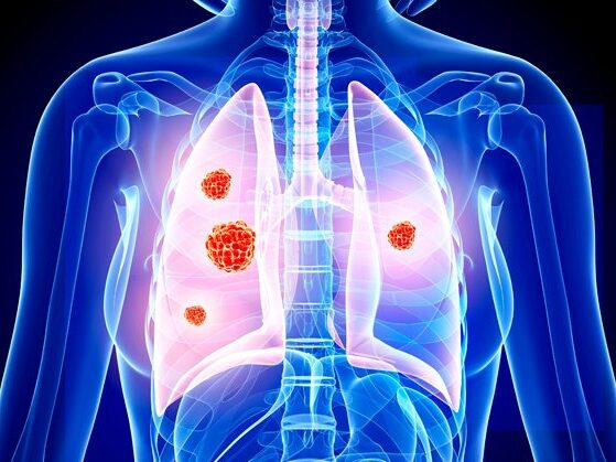 fam-trastuzumab