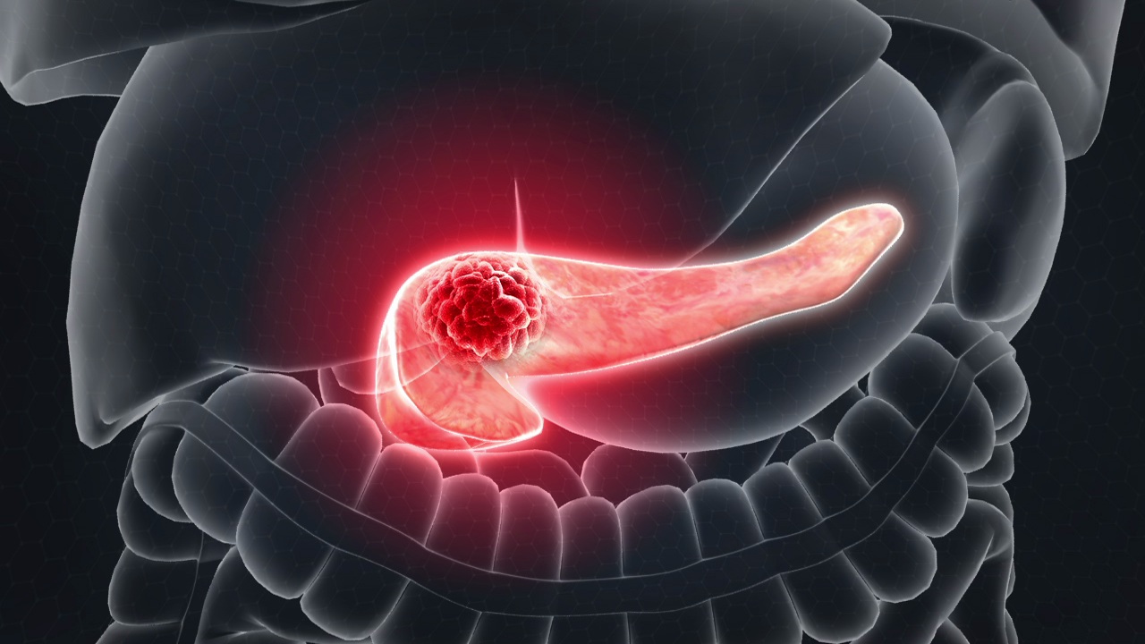 Pancreatic Cancer