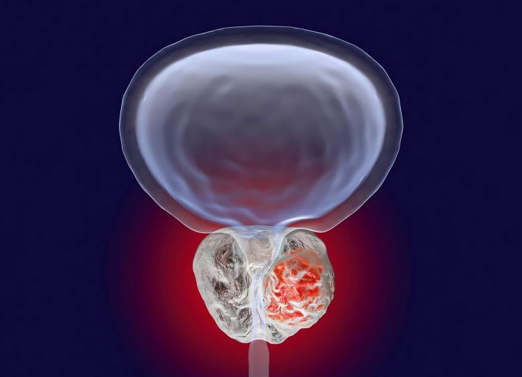 Prostate Cancer