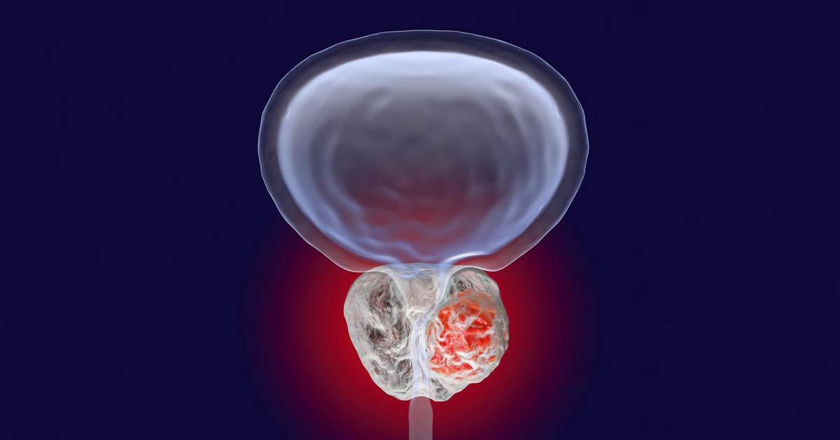 Prostatectomy