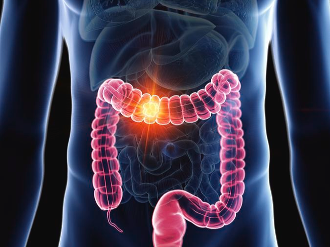 Colon Cancer