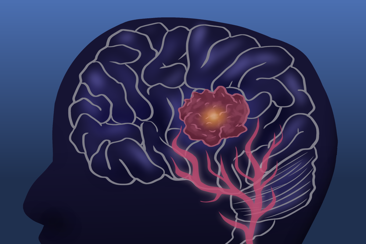 glioblastoma