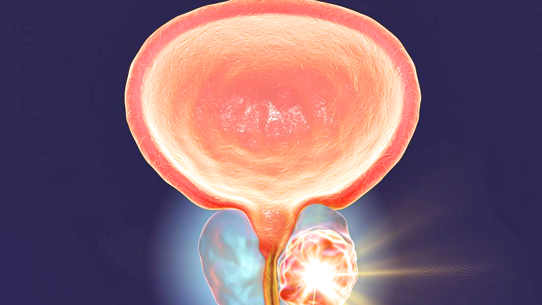 prostate cancer