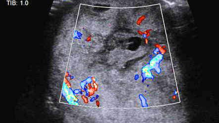 germ cell tumors