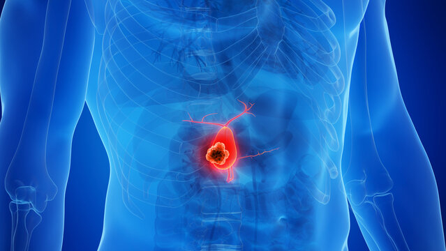 biliary tract cancers