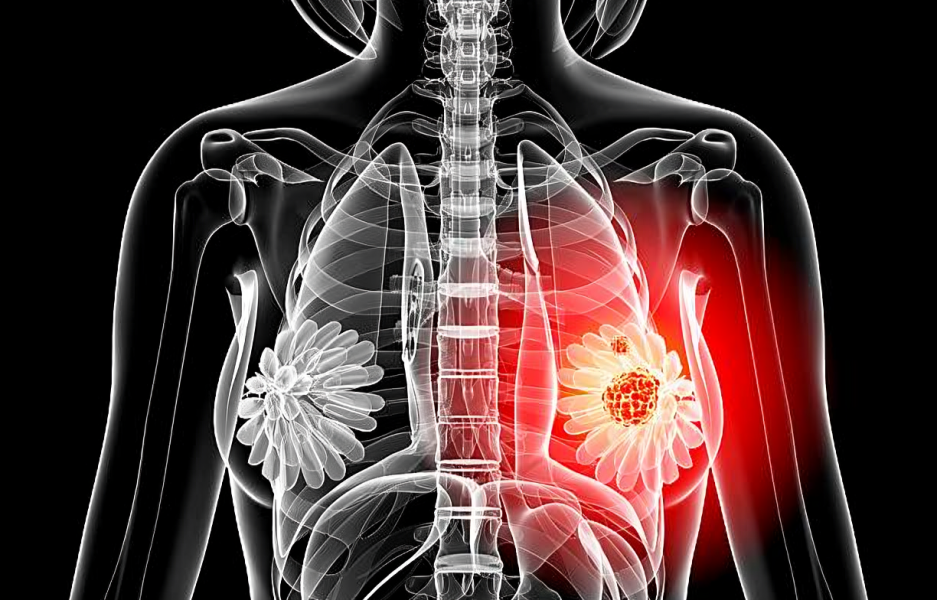 Internal Mammary Lymphadenopathy
