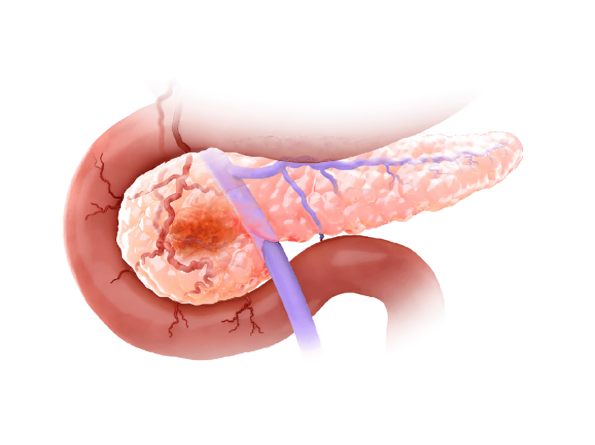 ctDNA