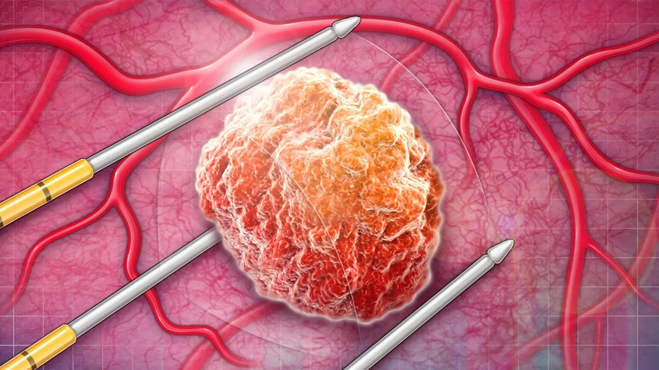 Prostate Cancer