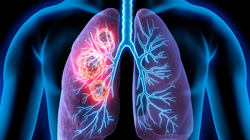 NSCLC, ICIs