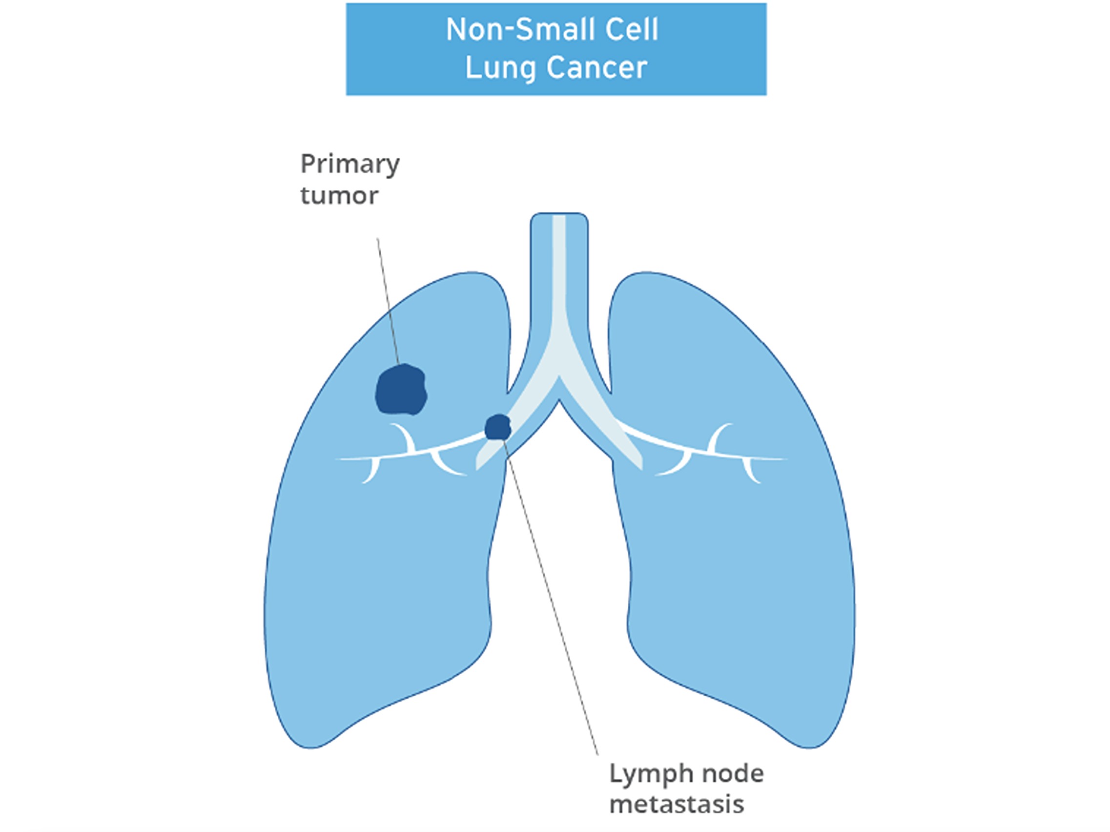 Trastuzumab rezetecan