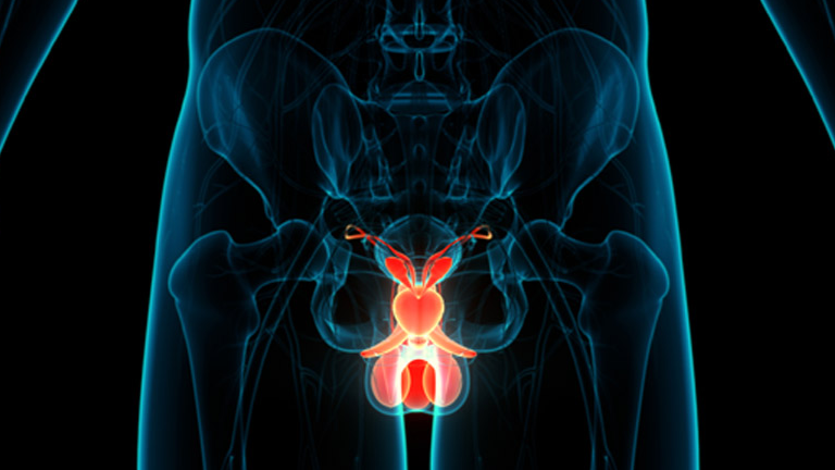 Prostate cancer