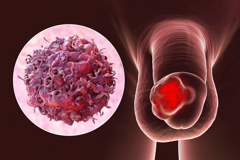 Updated ESMO-EURACAN