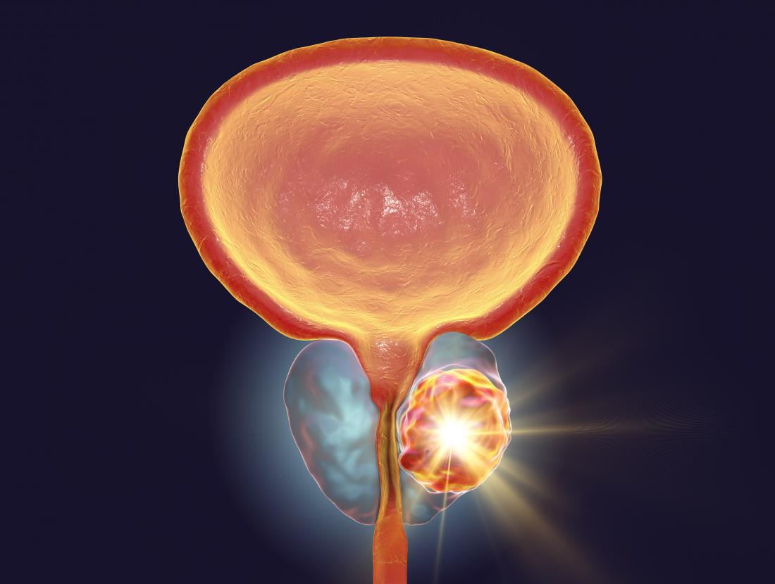 Prostate Cancer