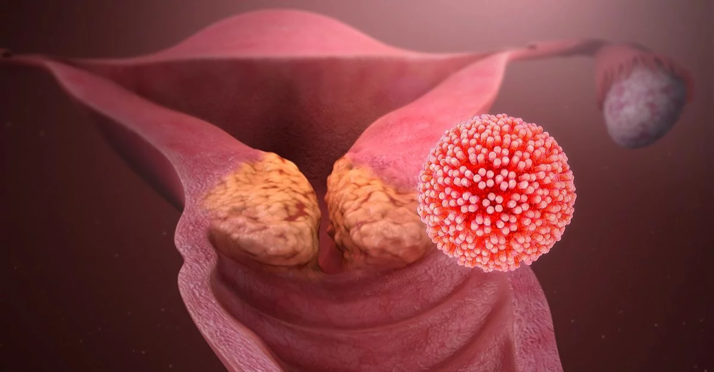 HPV genotypes
