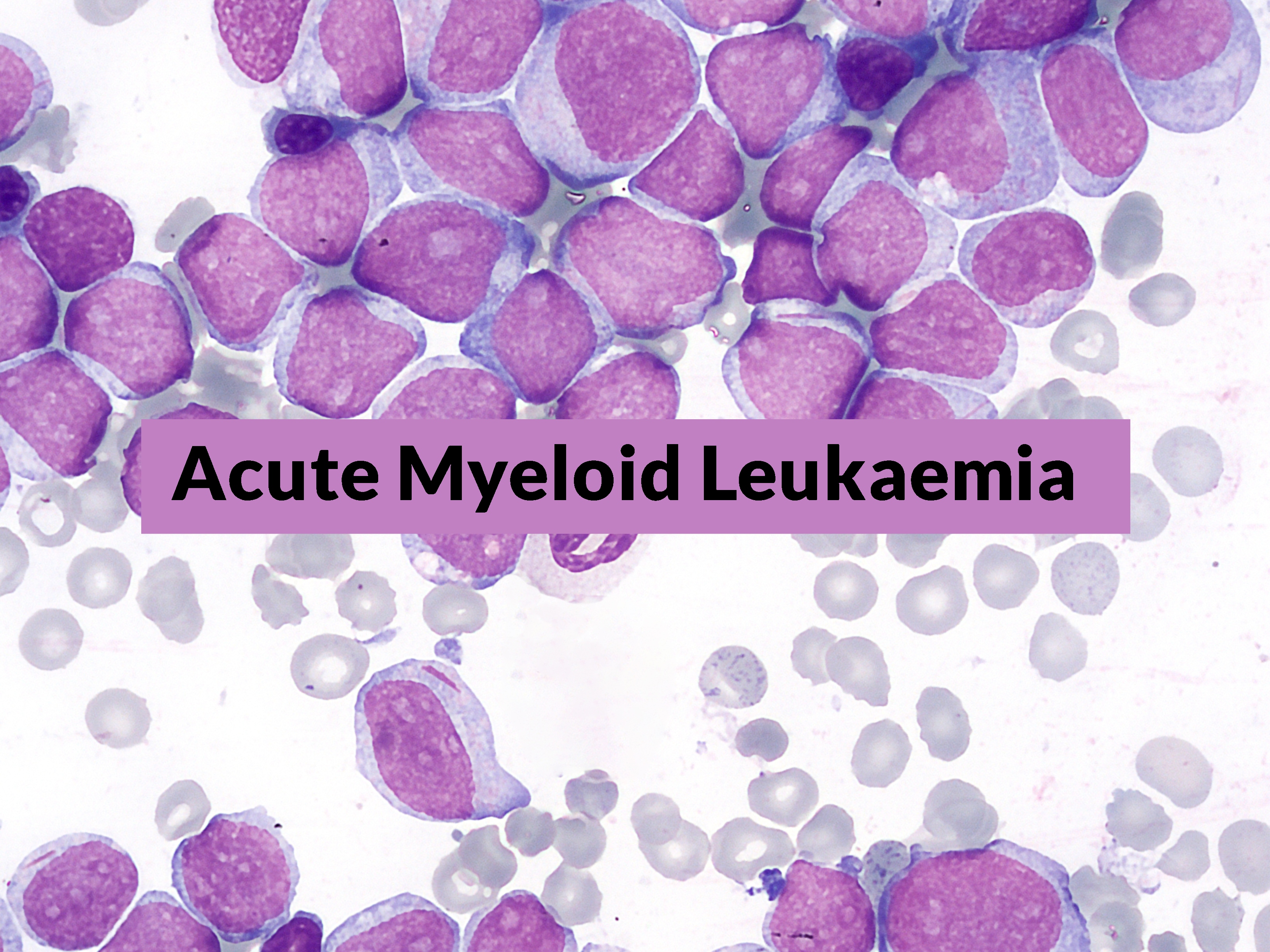 ELN classification of AML