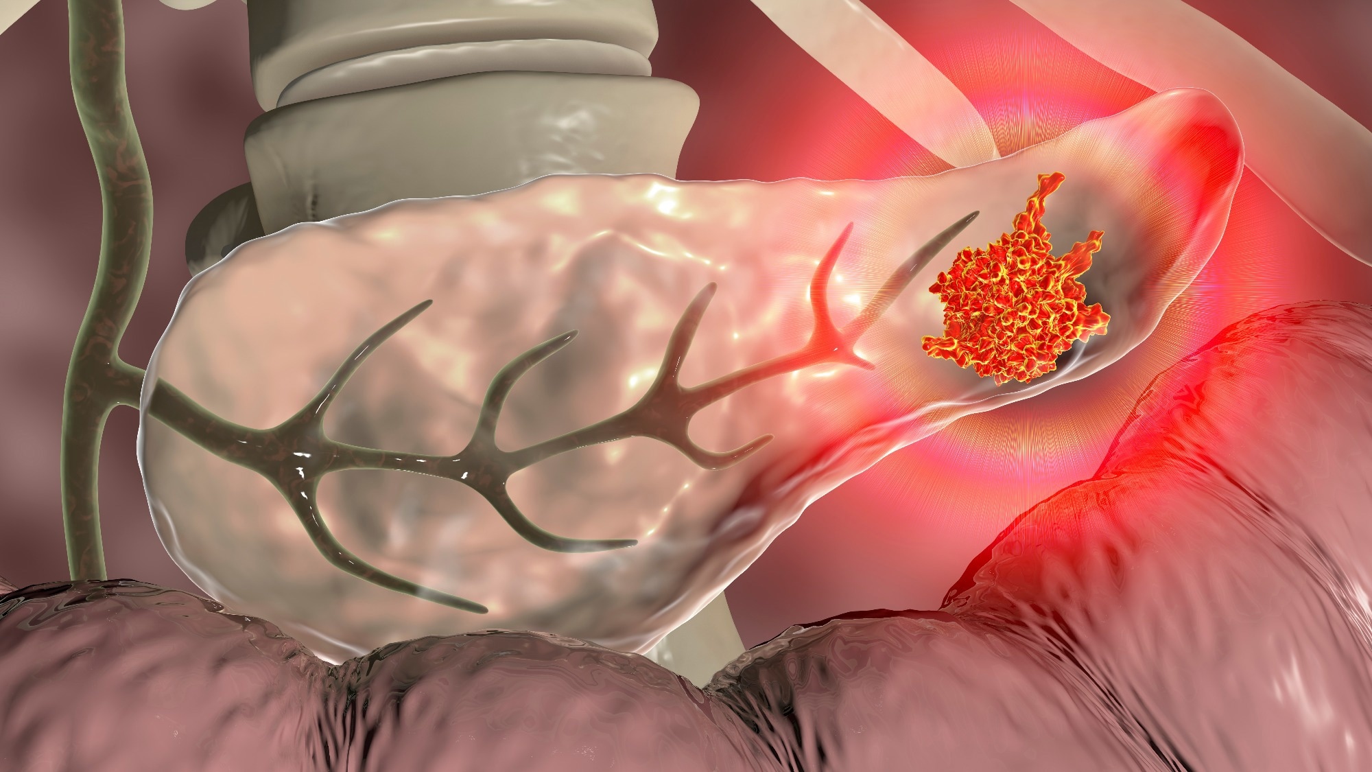 pancreatic ductal adenocarcinoma