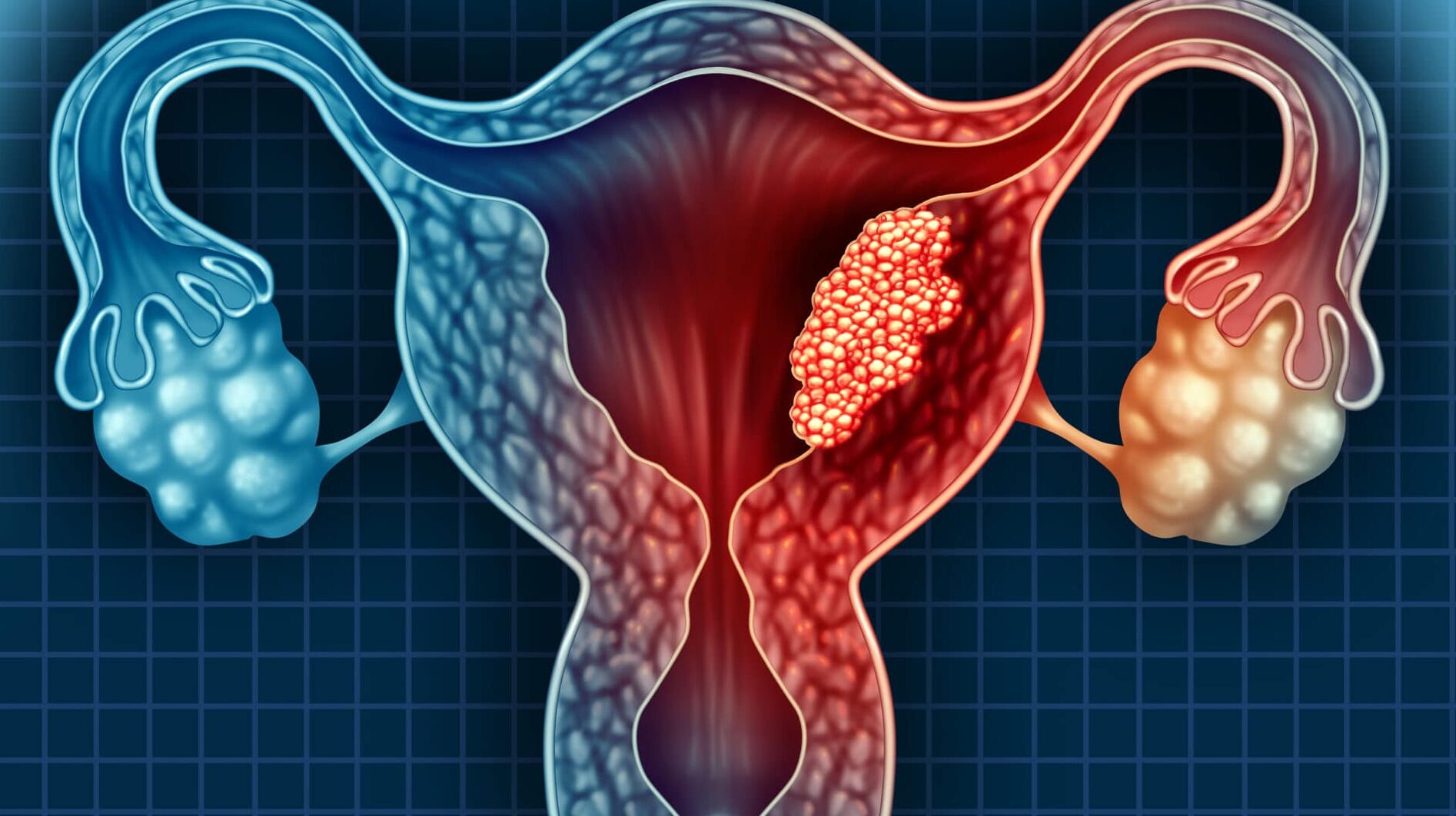 Sacituzumab govitecan