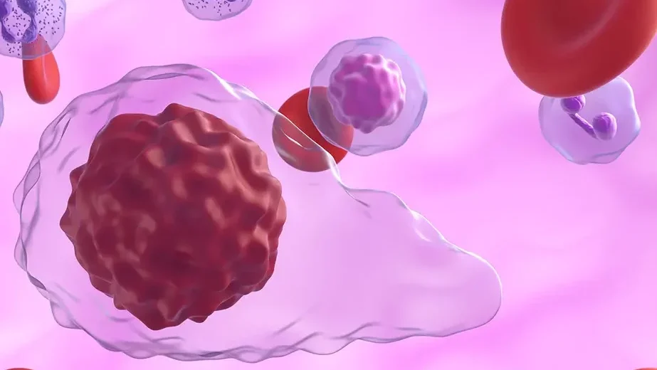 myelofibrosis