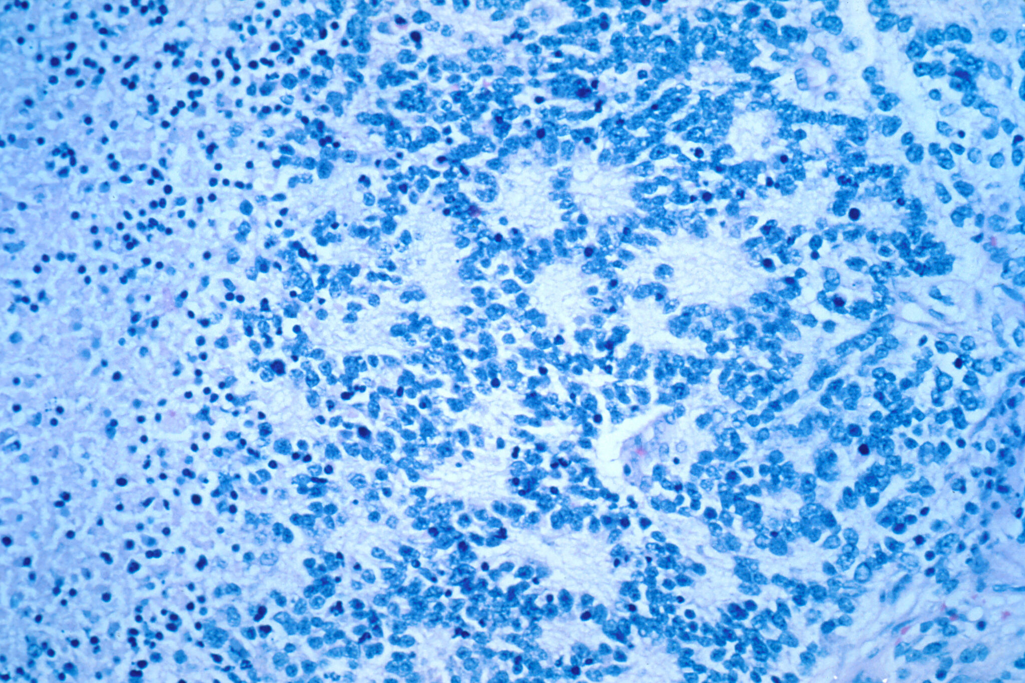 Neuroblastoma study