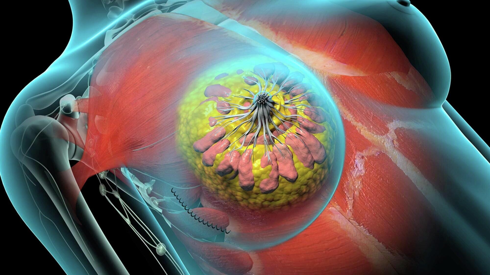 mastectomy