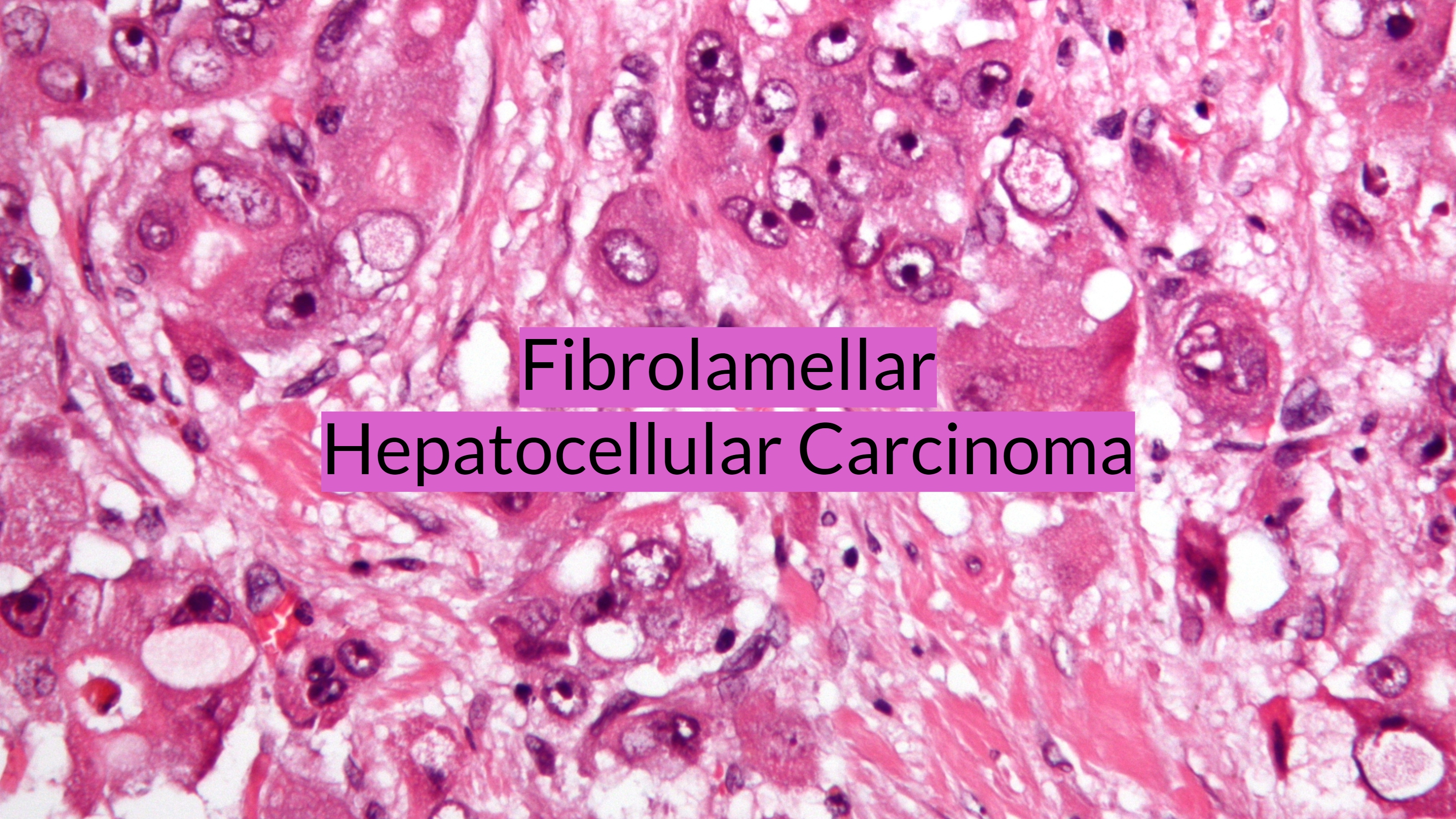 Fibrolamellar Carcinoma