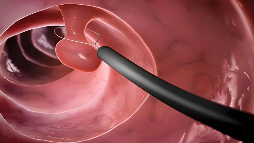 colonoscopy biopsies